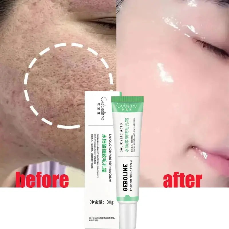 Salicylic Acid Pore Shrinking Cream Quick Elimination Large Pores Remove Blackehead Tighten Face Smooth Skin Korean Care Product - SPINGHAR